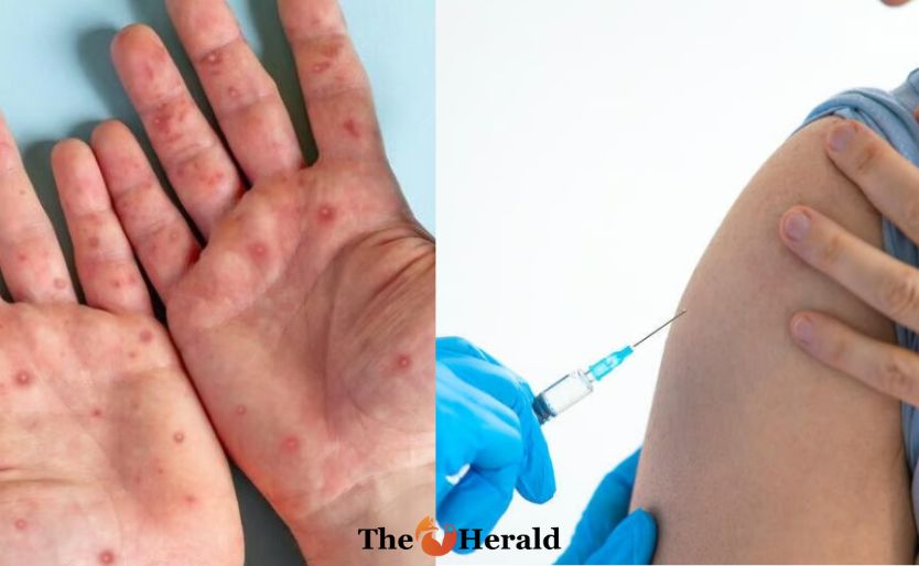 les risque du Mpox et ce qui peut être fait pour s'en protéger